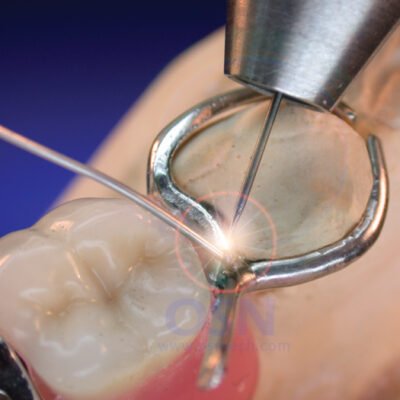 Saldatura laser dentale